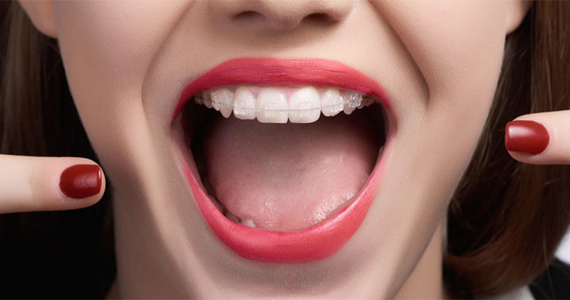 Todo lo que debes saber sobre los brackets de zafiro