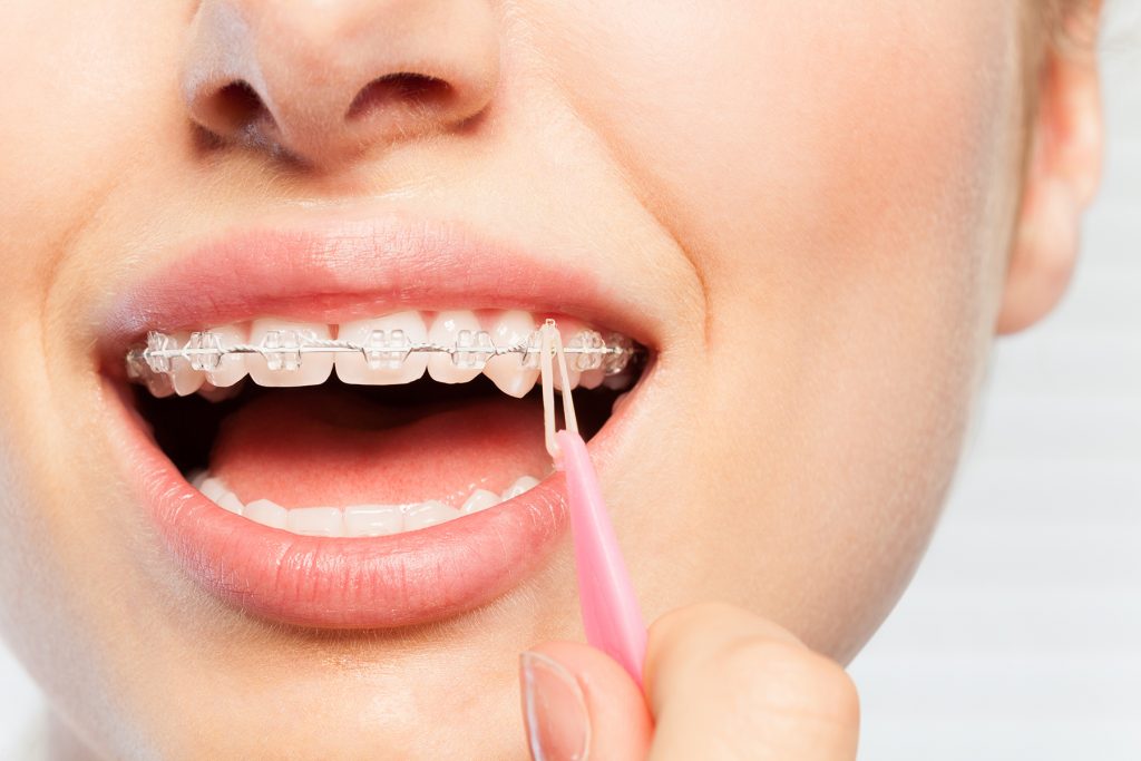 ¿Cómo cuidar los brackets de zafiro?